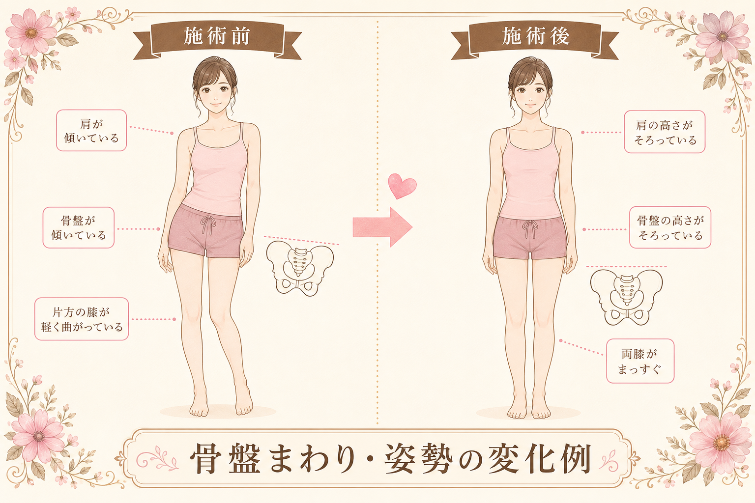 骨盤まわり 姿勢の変化例 Before After