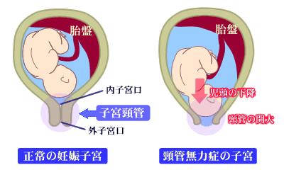 頸管無力症の子宮