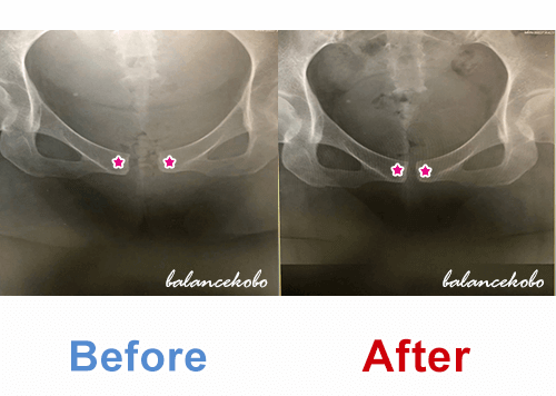 妊娠初期 後期 妊婦さんの仙骨の痛み改善