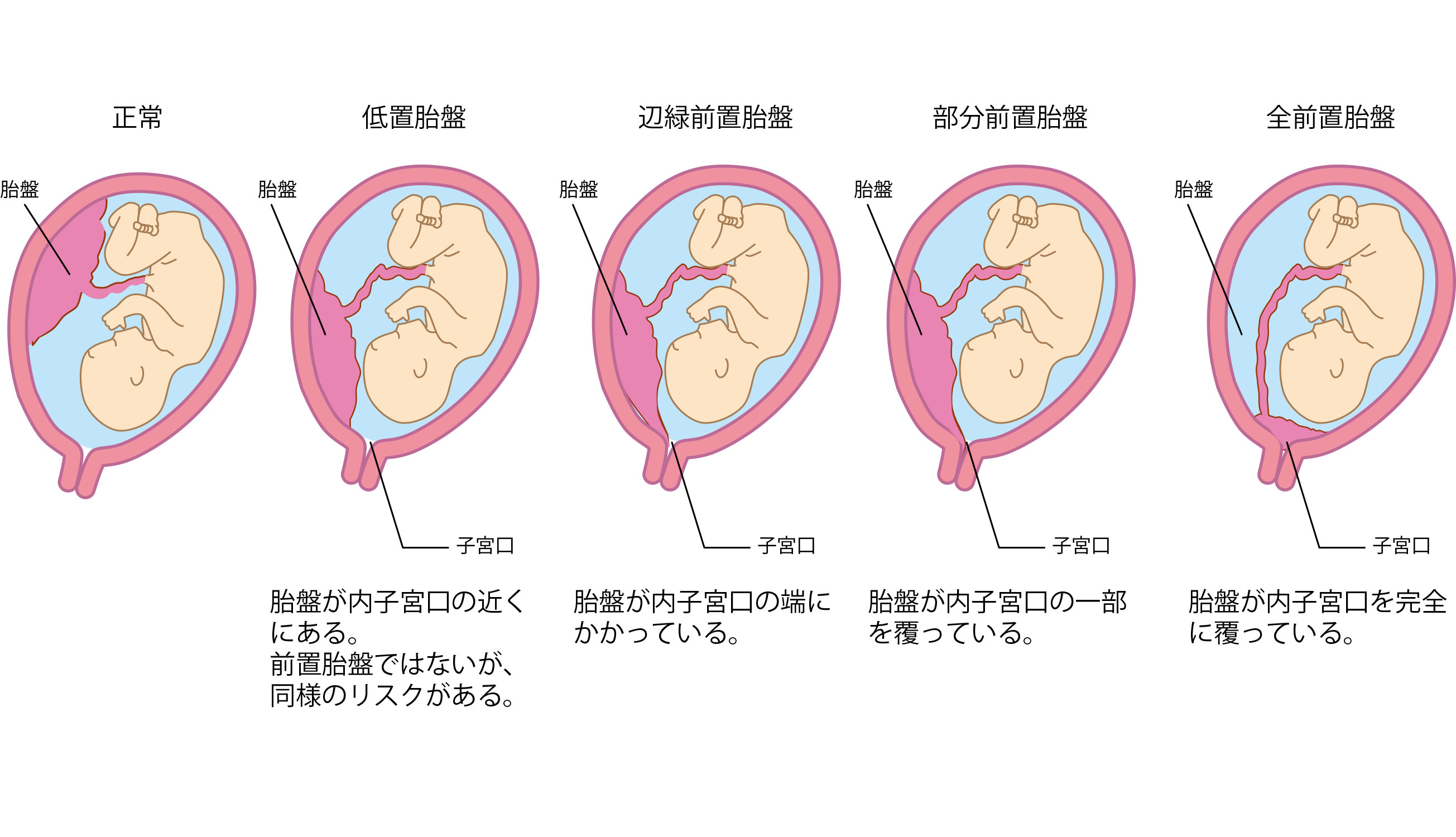 前 置 胎盤 について 正しい の は どれ か